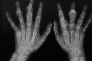 хондромиксоидная фиброма