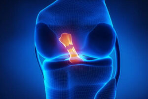 Лечение повреждения крестообразных связок коленного сустава в Израиле 