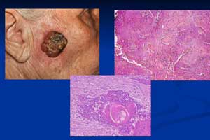 плоскоклеточный рак