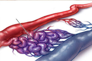 синдром Клиппеля-Треноне