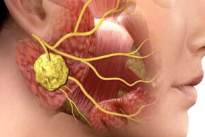 Лечение аденокистозного рака в Израиле 