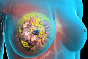 Лечение липидсекретирующего рака в Израиле 