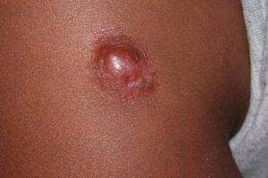 Лечение протуберанской дерматофибросаркомы в Израиле 