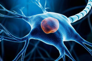 Лечение недифференцированной плеоморфной саркомы в Израиле 