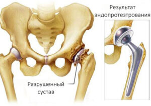 эндопротезирование тазобедренного сустава